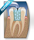 Painless Root Canal Treatment